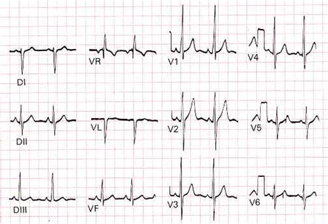 Cardiotruco Cálculo Eje Cardíaco Cardioprimaria Ferrol