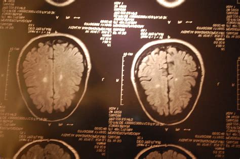 Mri Brain Scan Results White Spots
