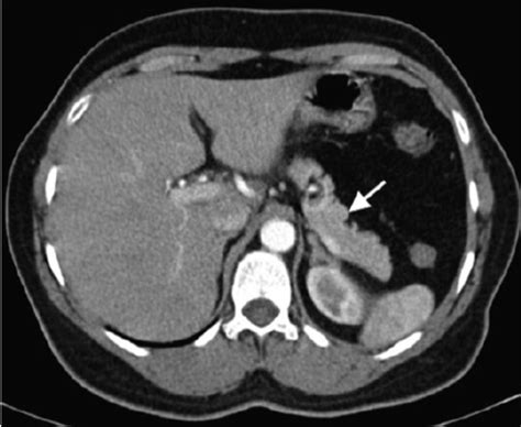 Arterial Phase Ct Scan The Lesion Is Barely Seen Arrow And Remains