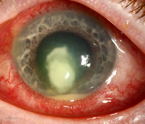 Acanthamoeba keratitis requires early diagnosis and treatment by an eye doctor to avoid vision loss. fungal keratitis