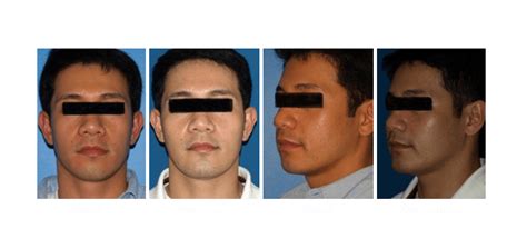 Facial Implants San Diego Facelift And Rhinoplasty Roy David Md Facial