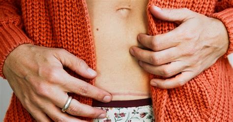 C Section Scars Types Of Incisions Healing And Minimizing Scars