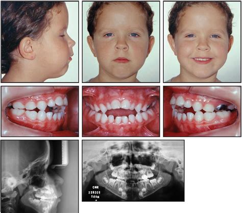 Eli5 Why Do People Get Crooked Teeth Rexplainlikeimfive