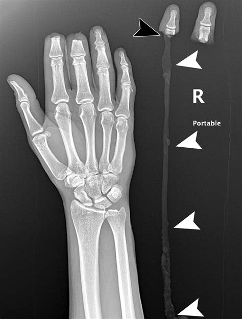 Avulsion Injuries Of The Hand And Wrist Radiographics