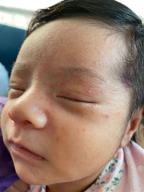 Newborn Rash On Face Babycenter