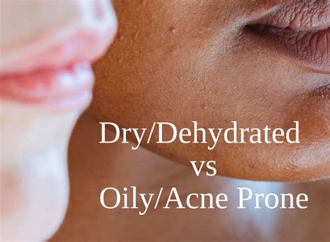 Drydehydrated Vs Oilyacne Prone How To Spot The Subtle Differences