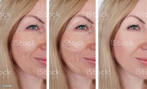 Woman Wrinkles Before And After Procedures Retouch Stock Photo