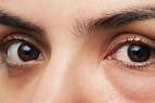 Eye Bags Treatments | Brisbane Skin Dermatologists