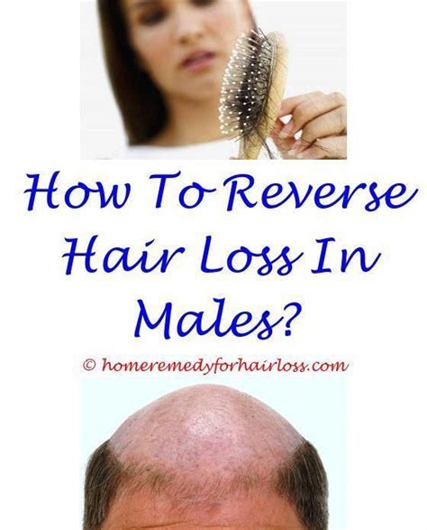 I heard hair loss is a possible side effect that can happen from accutane or roaccutane. Pin on Hair Loss Stinks