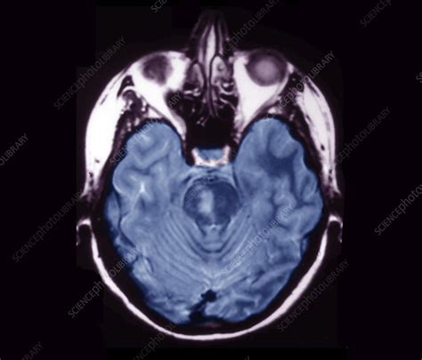 Brainstem Stroke Mri Scan Stock Image C0403208 Science Photo