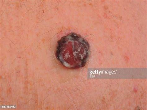 Melanoma Back Photos And Premium High Res Pictures Getty Images
