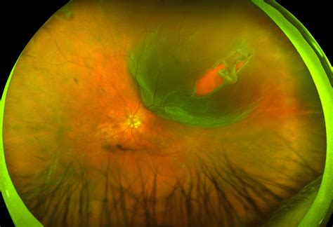 Retinal Detachment - Recognizing Pathology - Optos