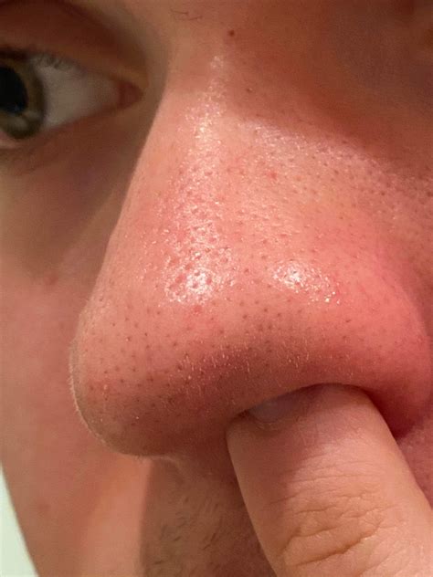 Need Help With Ice Pick Scars On Nose Scar Treatments