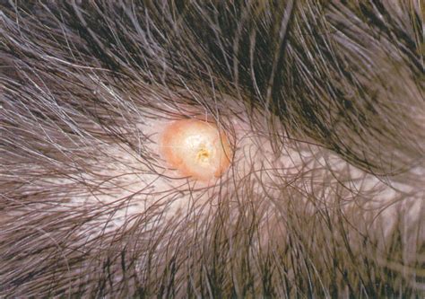 Medical Pictures Info Scalp Cyst