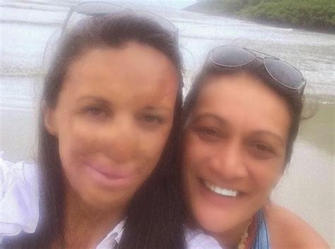 Inspirational Burns Victim Turia Pitt Shows Off New Nose Photos