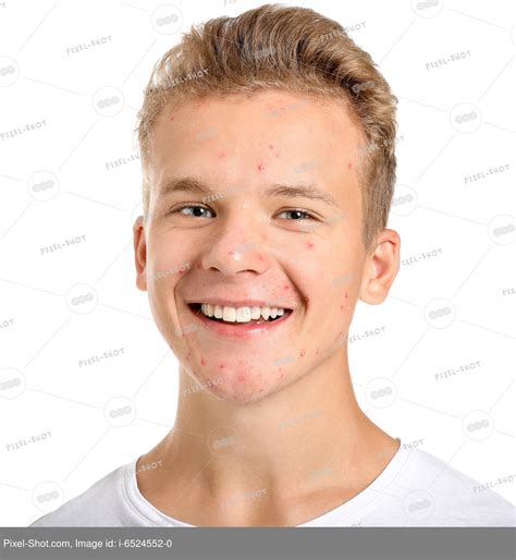 Teenage Boy With Acne Problem On White Background Stock Photography
