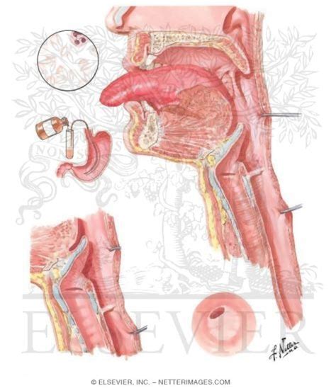 Dysphagia is the first and most prominent symptom. Plummer-Vinson syndrome/esophageal web. Causes, symptoms ...