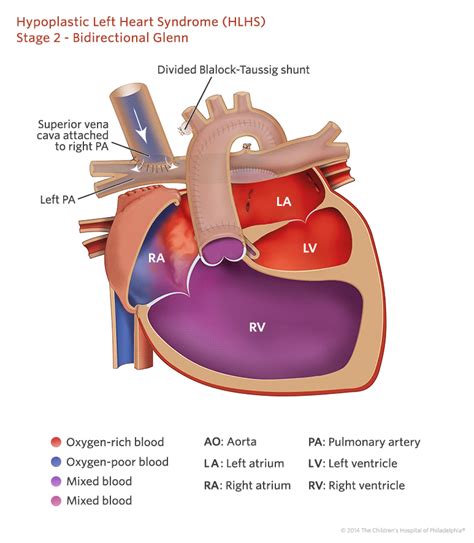 Hypoplastic Left Heart Syndrome Stage 2 Repair Illustration Norwood