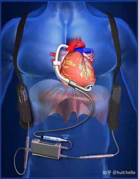 首发！离心式磁悬浮人工心脏专利分析报告 哔哩哔哩