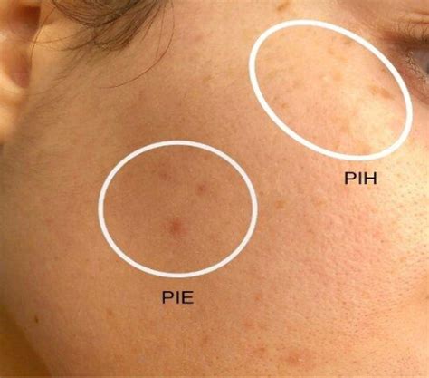 Post Inflammatory Hyperpigmentation Pih Dtap Clinic