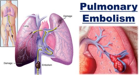 Pulmonary Embolism Causes Signs Symptoms Diagnosis Treatment