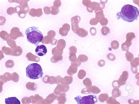 Dysplastic Monocytes 1