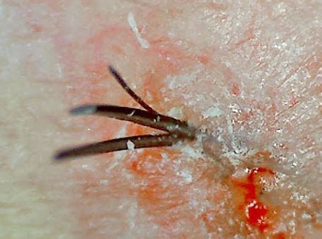 Multiple Two Hairs One Follicle Pubic Area Scalp Armpit Get Rid