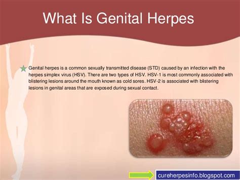 >>826 oh that's a good question, i'm biased for mona but it's simply too early to tell. Testing For Genital Herpes In Women — Herpes Free Me