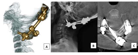 An Occipitocervical Fusion For Treatment Of A Bone Cyst Of The Atlas