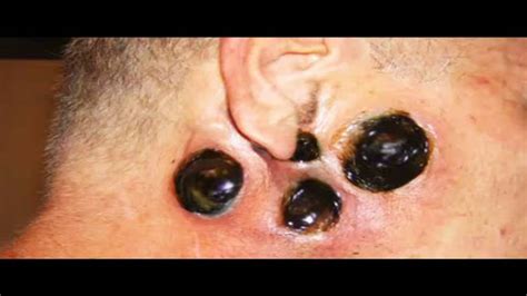 Pimples Zits And Cysts Blackhead Popping And Cyst Removal Week In