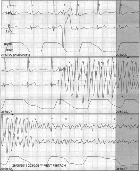 Ventricular Fibrillation Pulseless Electrical Activity And Sudden