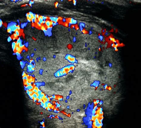 How to perform basic thyroid ultrasound using point of care ultrasound. 530 best thyroide images on Pinterest | Ovoid shape ...