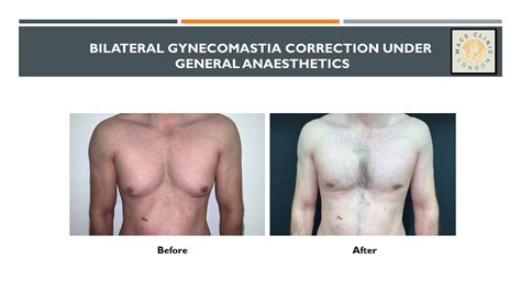 Gynecomastia Surgery Male Breast Reduction Gyno Surgery Uk