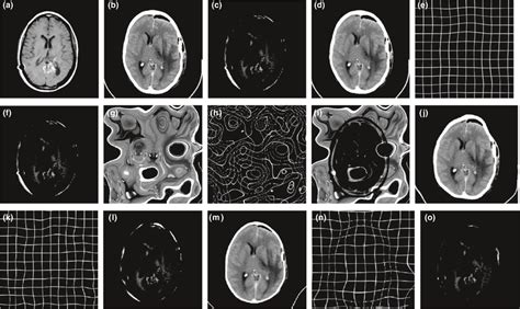 Brain Image Multimodality Registration Result A Mri Reference Image
