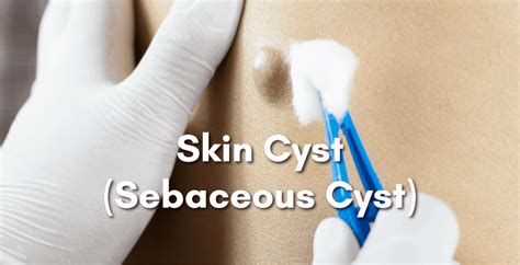 Skin Cyst Removal Singapore Treat Remove Cyst Singapore