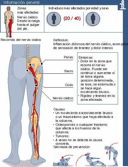 Qué Es La Ciática Y El Lumbago Y Cómo Puedes Tratarlo Vida Lúcida