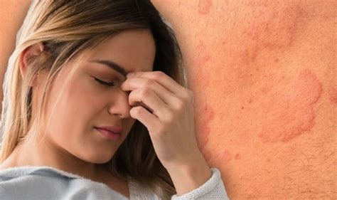 Fibromyalgia Symptoms Pain Could Be A Sign Skin Rash And Dry Skin