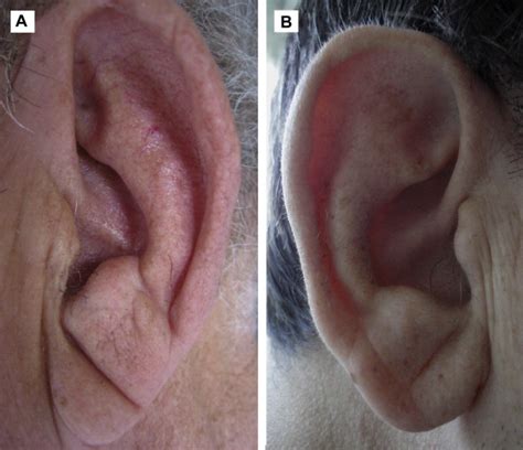 Earlobe Crease Shapes And Cardiovascular Events Thoracic Key