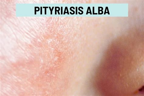 Pityriasis Alba What Causes These Dry White Patches On Skin