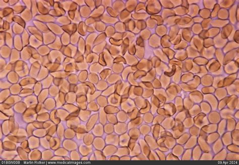 Stock Image Photomicrograph Of Sickle Shaped Red Blood Cells In The