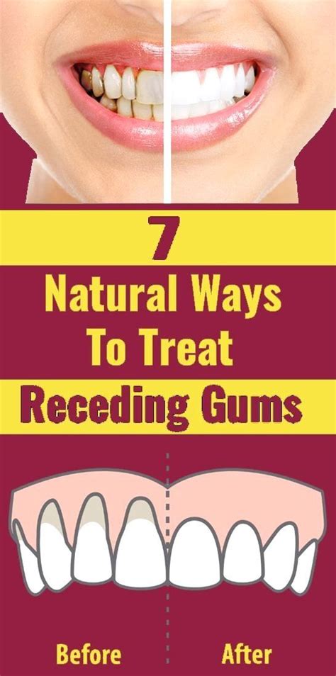 7 Natural Ways To Treat Receding Gums In 2020 Receding Gums Gum