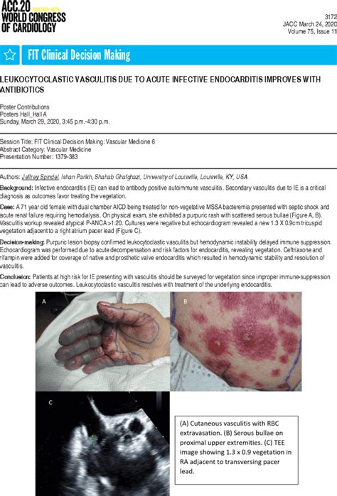 Acute Infective Endocarditis