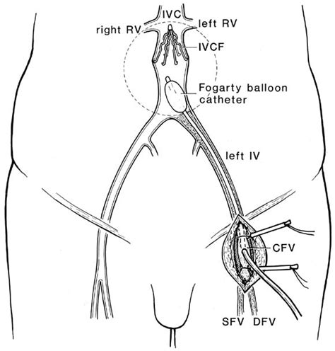 Insertion Of The Inferior Vena Cava Filter Followed By Iliofemoral
