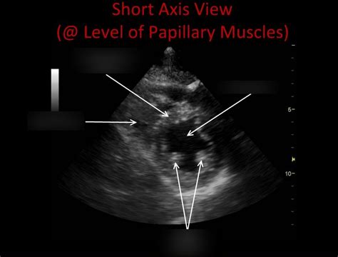 Parasternal Short Axis View Papillary Muscles Diagram Quizlet