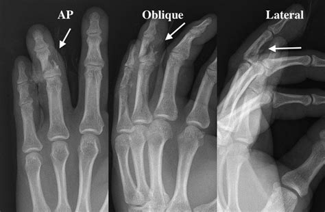 Finger Middle Phalanx Hand Surgery Source