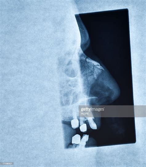 Xray Of A Broken Human Nose High Res Stock Photo Getty Images