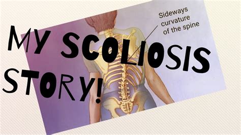 My Scoliosis Story And Questions For Yall Youtube