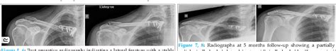 Figure 7 From Traumatic Floating Clavicle A Case Report Semantic Scholar
