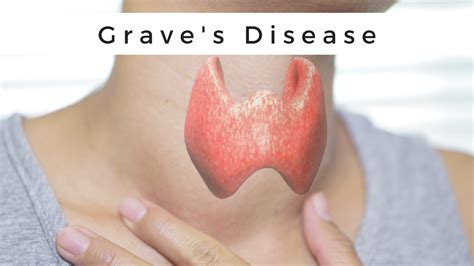 Graves Disease Hyperthyroidism Signs Symptoms Diagnosis Treatment