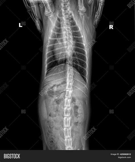 X Ray Chest Abdomen Image And Photo Free Trial Bigstock
